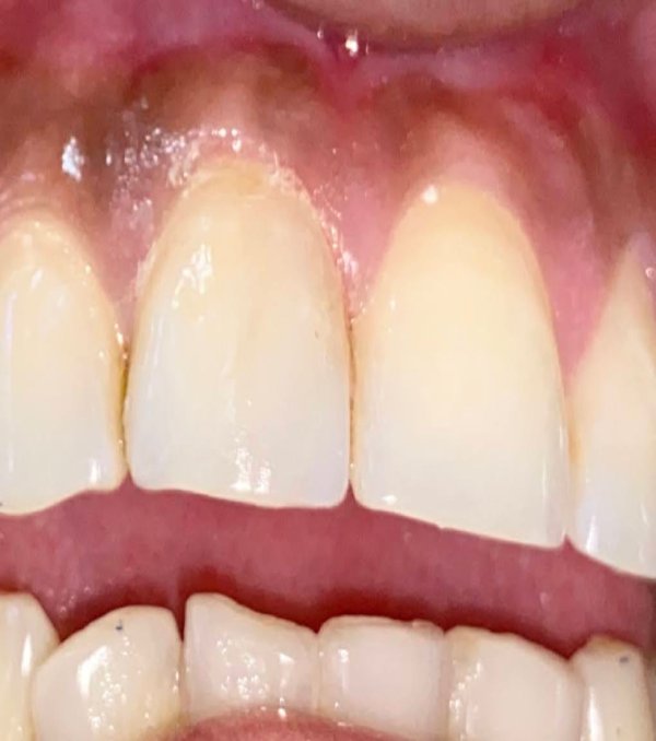 Aesthetic-Filling-3 (3) Aesthetic-Filling-3 (3)