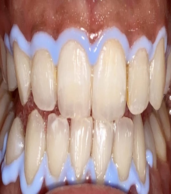 Bleaching-IMG_5654 Bleaching-IMG_5654