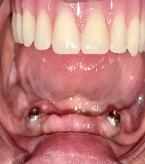 Denture-IMG_7376 (2) Denture-IMG_7376 (2)