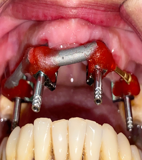 Implant Implant