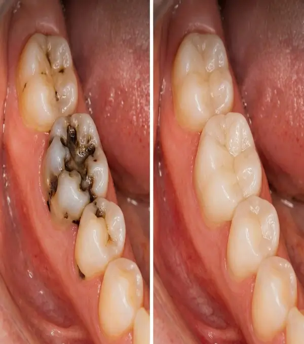 Thmb-Aesthetic-filling