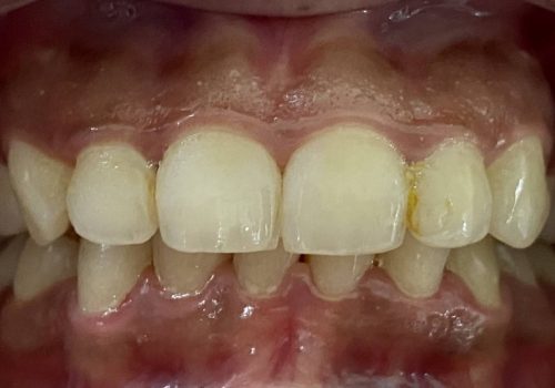 Bleaching-IMG_5650 Bleaching-IMG_5650