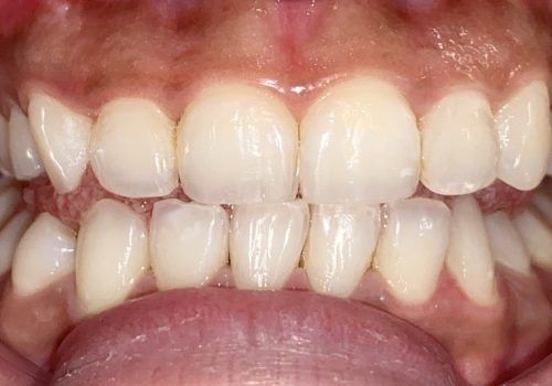 Bleaching-IMG_8837 Bleaching-IMG_8837