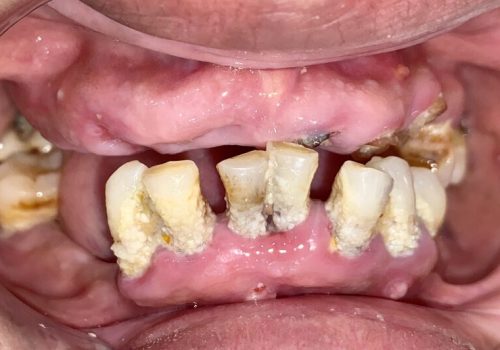 Denture-IMG_6229 Denture-IMG_6229