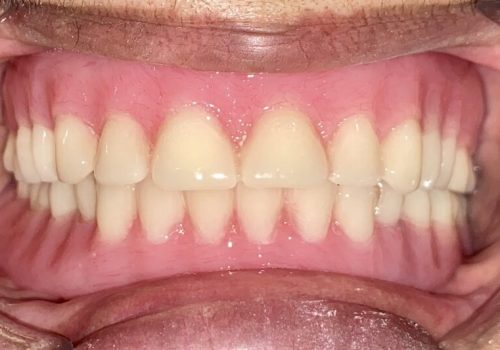 Denture-IMG_7388 Denture-IMG_7388