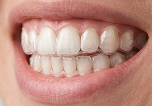 InvisibleAligner-A InvisibleAligner-A