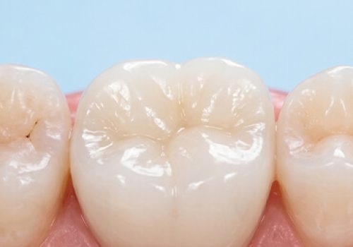 Root-Canal-Treatment-A Root-Canal-Treatment-A