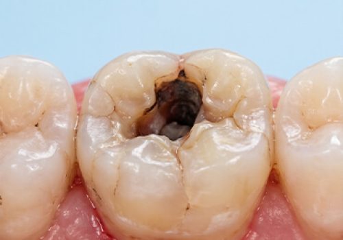 Root-Canal-Treatment-B Root-Canal-Treatment-B
