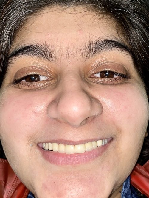 Smile-design-IMG_4069 Smile-design-IMG_4069