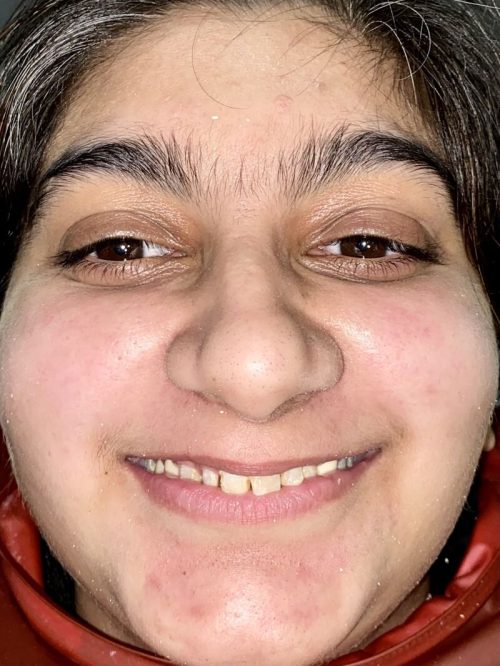 Smile-designI-IMG_4026 Smile-designI-IMG_4026