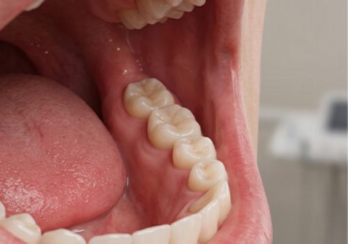 Wisdom Tooth Removal Wisdom Tooth Removal