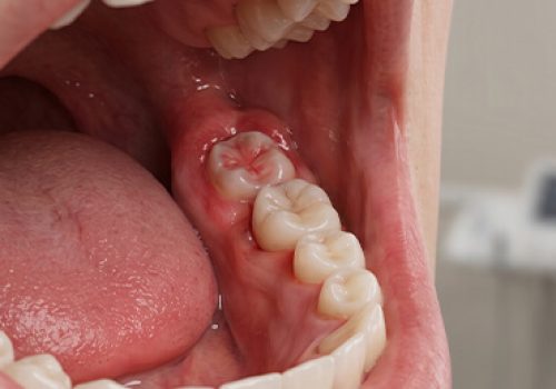 Wisdom Tooth Removal1 Wisdom Tooth Removal1