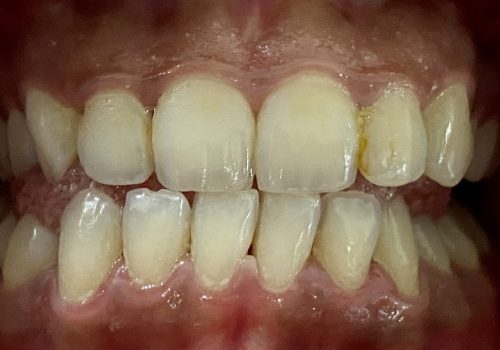 bleaching1 bleaching1