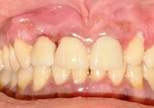 tooth1hour-after tooth1hour-after